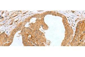 Immunohistochemistry of paraffin-embedded Human thyroid cancer tissue using MRPS28 Polyclonal Antibody at dilution of 1:60(x200) (MRPS28 antibody)
