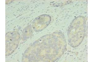 Immunohistochemistry of paraffin-embedded human gastric cancer using ABIN7167836 at dilution of 1:100 (RDH12 antibody  (AA 1-316))