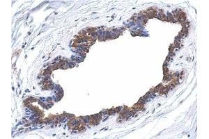 Immunohistochemical analysis of paraffin-embedded breast ca, using AP22398PU-N MAPK4 antibody at 1/500 dilution. (MAPK4 antibody  (N-Term))