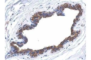 Immunohistochemical analysis of paraffin-embedded breast ca, using AP22398PU-N MAPK4 antibody at 1/500 dilution.