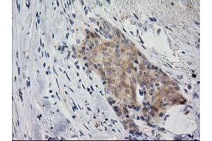 Immunohistochemical staining of paraffin-embedded Adenocarcinoma of Human breast tissue using anti-EIF4E2 mouse monoclonal antibody.