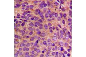 Immunohistochemical analysis of Cytokeratin 18 staining in human breast cancer formalin fixed paraffin embedded tissue section. (Cytokeratin 18 antibody  (C-Term))