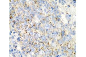 Immunohistochemistry of paraffin-embedded Human esophageal cancer using PRKCQ Polyclonal Antibody at dilution of 1:200 (40x lens). (PKC theta antibody)