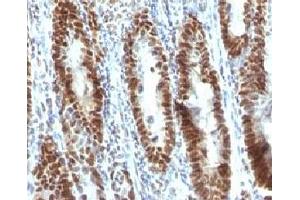 Formalin-fixed, paraffin-embedded human gastric carcinoma stained with TOX3 antibody (TOX3/1123). (TOX3 antibody  (AA 200-400))
