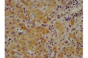 IHC image of ABIN7148361 diluted at 1:700 and staining in paraffin-embedded human liver cancer performed on a Leica BondTM system. (C4A antibody  (AA 1027-1186))