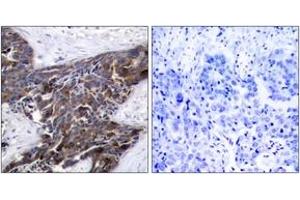 Immunohistochemistry analysis of paraffin-embedded human breast carcinoma, using Connexin 43 (Phospho-Ser367) Antibody. (Connexin 43/GJA1 antibody  (pSer367))
