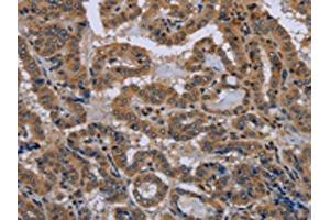 The image on the left is immunohistochemistry of paraffin-embedded Human thyroid cancer tissue using (NPHS2 Antibody) at dilution 1/40, on the right is treated with synthetic peptide. (Podocin antibody)