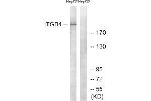 Immunohistochemistry analysis of paraffin-embedded human breast carcinoma tissue using ITGB4 (Ab-1510) antibody. (Integrin beta 4 antibody)