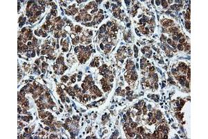 Immunohistochemical staining of paraffin-embedded Carcinoma of liver tissue using anti-LEMD3mouse monoclonal antibody. (LEMD3 antibody)