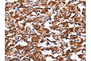 The image on the left is immunohistochemistry of paraffin-embedded Human thyroid cancer tissue using ABIN7191188(KCNJ9 Antibody) at dilution 1/15, on the right is treated with synthetic peptide.