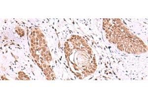 Immunohistochemistry of paraffin-embedded Human esophagus cancer tissue using RUVBL1 Polyclonal Antibody at dilution of 1:85(x200) (RUVBL1 antibody)