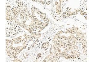 ABIN7094796 and ABIN7098847 at 1/100 staining Human breast cancer by IHC-P. (SF3B1 antibody  (N-Term))