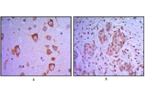 Immunohistochemical analysis of paraffin-embedded human brain tissue (A) and breast tumor (B) uing ETS1 antibody. (ETS1 antibody)