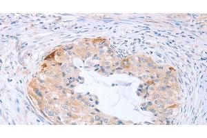 Immunohistochemistry of paraffin-embedded Human cervical cancer tissue using CARD6 Polyclonal Antibody at dilution 1:60 (CARD6 antibody)