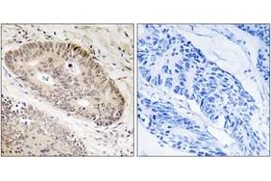Immunohistochemistry analysis of paraffin-embedded human lung carcinoma tissue, using ALS2CR8 Antibody. (Calcium Responsive Transcription Factor (CARF) (AA 311-360) antibody)