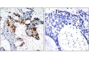 Immunohistochemistry analysis of paraffin-embedded human breast carcinoma tissue, using Estrogen Receptor-alpha (Ab-118) Antibody. (Estrogen Receptor alpha antibody  (AA 91-140))