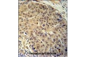 BUD13 antibody (C-term) (ABIN654718 and ABIN2844407) immunohistochemistry analysis in formalin fixed and paraffin embedded human hepatocarcinoma followed by peroxidase conjugation of the secondary antibody and DAB staining. (BUD13 antibody  (C-Term))