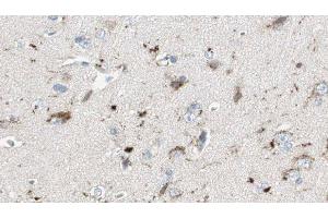 ABIN6275683 at 1/100 staining Human brain cancer tissue by IHC-P. (WASF3 antibody  (Internal Region))