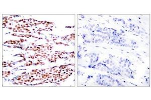 Immunohistochemical analysis of paraffin-embedded human breast carcinoma tissue using JunB(Phospho-Ser79) Antibody(left) or the same antibody preincubated with blocking peptide(right). (JunB antibody  (pSer79))