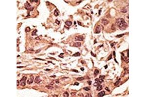 IHC analysis of FFPE human breast carcinoma tissue stained with the SIRT6 antibody (SIRT6 antibody  (AA 290-319))