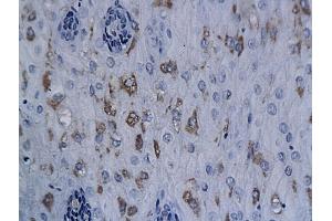 Formalin-fixed and paraffin embedded human esophageal cancer labeled with Anti-XRCC1 Polyclonal Antibody, Unconjugated (ABIN673539) followed by conjugation to the secondary antibody and DAB staining (XRCC1 antibody  (AA 1-120))