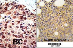 Formalin-fixed and paraffin-embedded human prostata carcinoma tissue reacted with PRMT3 Antibody , which was peroxidase-conjugated to the secondary antibody, followed by DAB staining. (PRMT3 antibody  (C-Term))