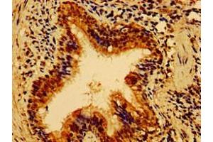 Immunohistochemistry of paraffin-embedded human lung cancer using ABIN7155006 at dilution of 1:100 (HS2ST1 antibody  (AA 29-229))
