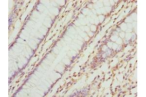 Immunohistochemistry of paraffin-embedded human colon cancer using ABIN7173063 at dilution of 1:100 (TMEM143 antibody  (AA 8-278))