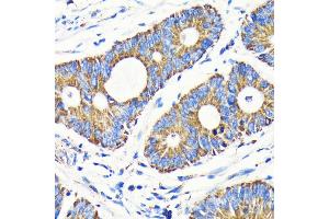 Immunohistochemistry of paraffin-embedded human colon carcinoma using VD antibody (ABIN7271335) at dilution of 1:100 (40x lens). (VDAC1 antibody)
