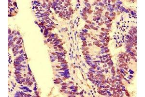 Immunohistochemistry of paraffin-embedded human colon cancer using ABIN7161302 at dilution of 1:100 (NOTCH3 antibody  (AA 1301-1496))