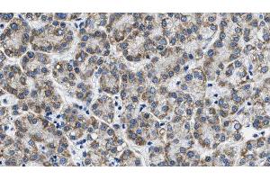 ABIN6268770 at 1/100 staining Human liver cancer tissue by IHC-P. (AQP3 antibody  (Internal Region))