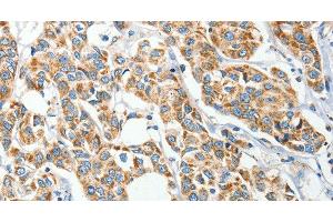 Immunohistochemistry of paraffin-embedded Human breast cancer tissue using IFT74 Polyclonal Antibody at dilution 1:60 (IFT74 antibody)