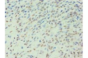 Immunohistochemistry of paraffin-embedded human breast cancer using ABIN7141988 at dilution of 1:100 (BCKDK antibody  (AA 153-412))