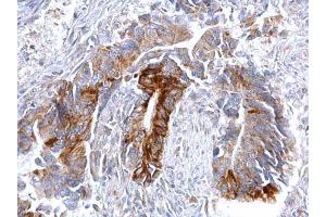IHC-P Image CCR3 antibody [C2C3], C-term detects CCR3 protein at cytosol on human colon carcinoma by immunohistochemical analysis. (CCR3 antibody  (C-Term))