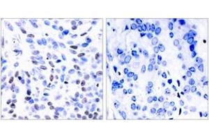 Immunohistochemistry analysis of paraffin-embedded human breast carcinoma tissue, using NF-kappaB p100/p52 (Ab-865) Antibody. (NFKB2 antibody  (AA 833-882))
