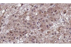 ABIN6277456 at 1/100 staining Human liver cancer tissue by IHC-P. (SCTR antibody  (Internal Region))