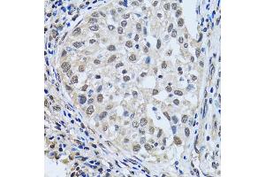 Immunohistochemistry of paraffin-embedded human lung cancer using LSM4 antibody (ABIN5973492) at dilution of 1/100 (40x lens). (LSM4 antibody)