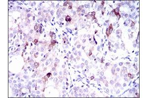 Immunohistochemical analysis of paraffin-embedded cervical cancer tissues using SLC27A5 mouse mAb with DAB staining.