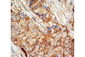 IHC testing of FFPE human breast carcinoma tissue with GCK antibody. (GCK antibody  (AA 1-30))