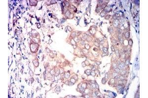 Immunohistochemical analysis of paraffin-embedded breast cancer tissues using FAP mouse mAb with DAB staining. (FAP antibody  (AA 26-264))