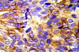Immunohistochemistry (IHC) analyzes of p-EGFR antibody in paraffin-embedded human lung carcinoma tissue. (EGFR antibody  (pTyr1110))