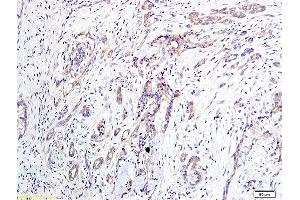 Formalin-fixed and paraffin embedded human pancreatic cancer labeled with Anti-EDG2/LPA1 Polyclonal Antibody, Unconjugated (ABIN681103) at 1:400 followed by conjugation to the secondary antibody and DAB staining