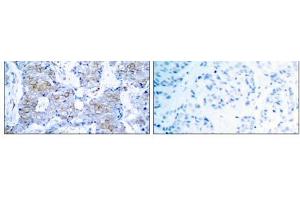 Immunohistochemical analysis of paraffin- embedded human breast carcinoma tissue using HER2 (Ab-1248) antibody (E021072). (ErbB2/Her2 antibody)