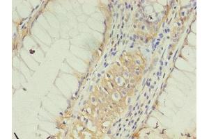 Immunohistochemistry of paraffin-embedded human colon cancer using ABIN7147867 at dilution of 1:100 (Claudin 15 antibody  (AA 72-128))