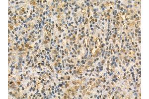 UMP/CMP kinase Mouse Monoclonal Antibody at 1/100 staining human gastric cancer by IHC-P.