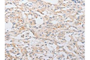 The image on the left is immunohistochemistry of paraffin-embedded Human thyroid cancer tissue using ABIN7131038(SERPINE2 Antibody) at dilution 1/20, on the right is treated with fusion protein. (SERPINE2 antibody)