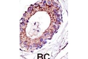 Formalin-fixed and paraffin-embedded human cancer tissue reacted with the primary antibody, which was peroxidase-conjugated to the secondary antibody, followed by DAB staining. (UBE4A antibody  (C-Term))