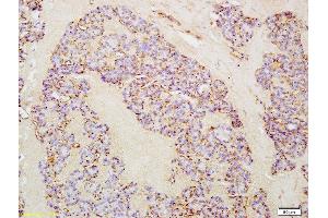 Formalin-fixed and paraffin embedded human thyroid cancer labeled with Anti-IL-21 Polyclonal Antibody, Unconjugated (ABIN748133) at 1:200 followed by conjugation to the secondary antibody and DAB staining (IL-21 antibody  (AA 65-155))