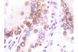 Immunohistochemistry analysis with EP300 / P300 antibody in paraffin-embedded human lung carcinoma tissue.