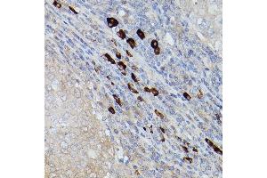 Immunohistochemistry of paraffin-embedded human breast cancer using UBE2L6 Rabbit pAb (ABIN1683197, ABIN3018773, ABIN3018774 and ABIN7101658) at dilution of 1:250 (40x lens). (UBE2L6 antibody)